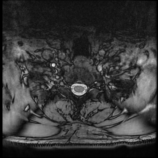 Cervical disc extrusion (Radiopaedia 59074-66364 G 95).jpg