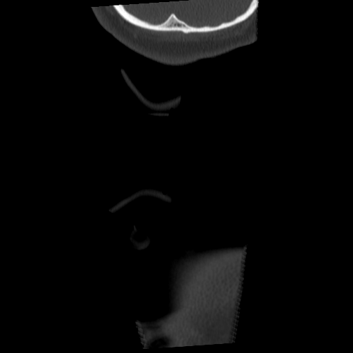 Cervical schwannoma (Radiopaedia 57979-64974 Coronal bone window 70).png