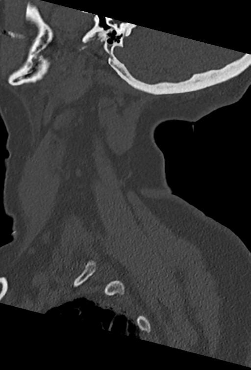 Cervical spine ACDF loosening (Radiopaedia 48998-54070 Sagittal bone window 17).png