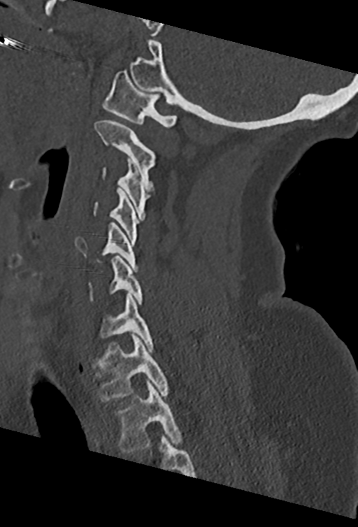 Cervical spine ACDF loosening (Radiopaedia 48998-54070 Sagittal bone window 56).png