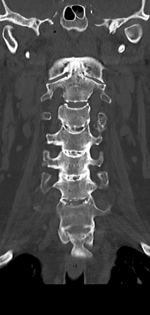 Cervical spine fracture - chalk stick (Radiopaedia 39116-41323 Coronal bone window 20).png