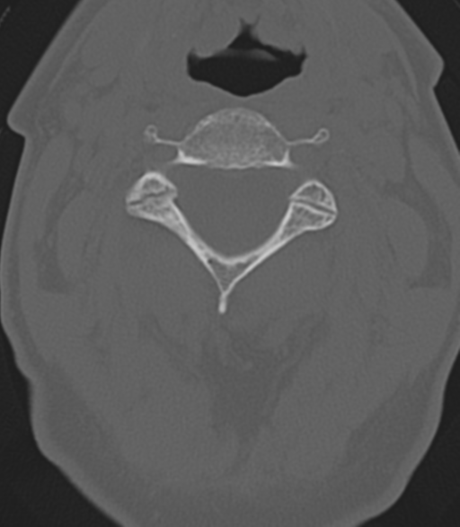 File:Cervical spine fractures with vertebral artery dissection (Radiopaedia 53296-59268 Axial bone window 21).png