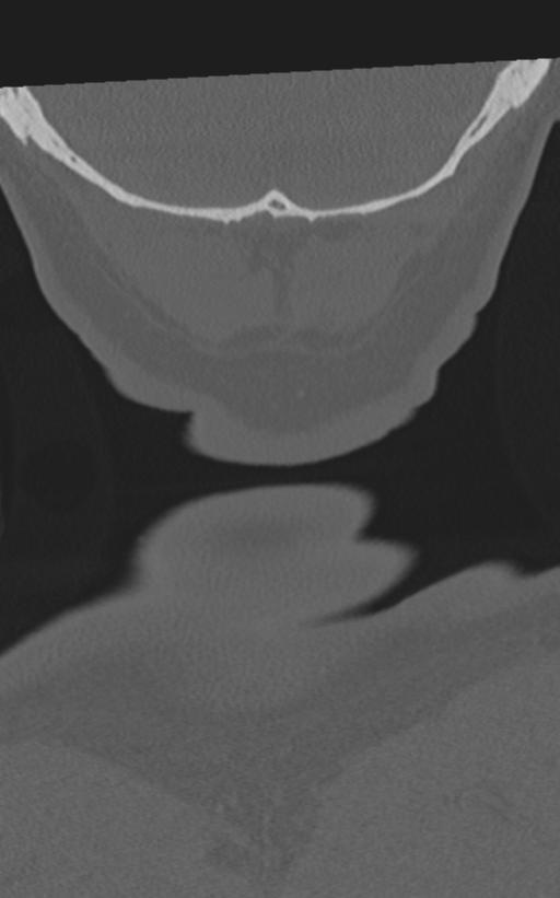 Cervical spine fractures with vertebral artery dissection (Radiopaedia 53296-59268 Coronal bone window 76).png