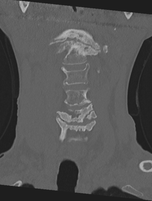 Cervical spondylolysis (Radiopaedia 49616-54811 Coronal bone window 11).png
