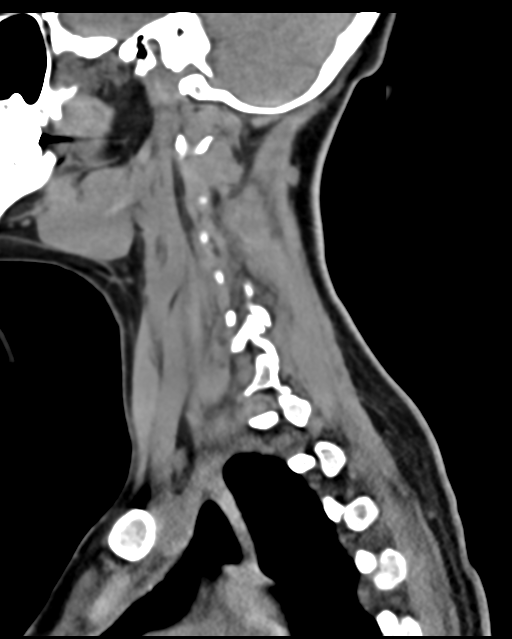 Cervical tuberculous spondylitis (Radiopaedia 39149-41365 D 19).png