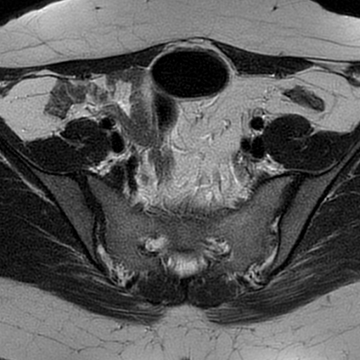 File:Cesarean scar ectopic pregnancy (Radiopaedia 77286-89362 Axial T2 13).jpg