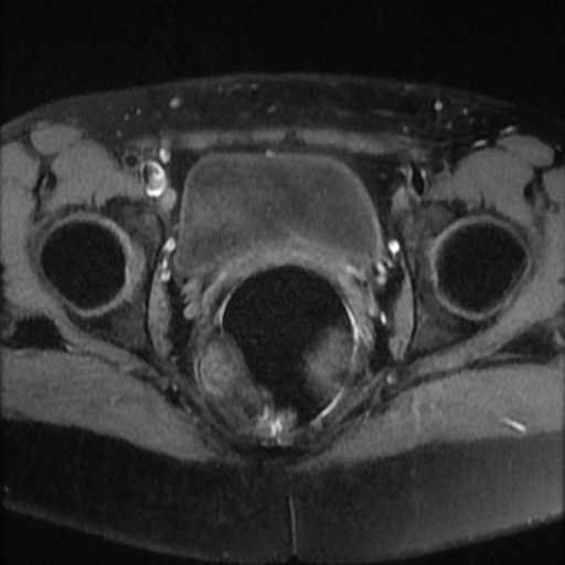 File:Cesarian section scar endometriosis (Radiopaedia 66520-75799 Axial T1 fat sat 19).jpg