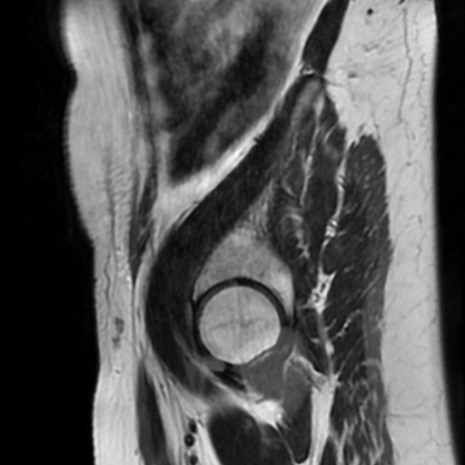 File:Cesarian section scar endometriosis (Radiopaedia 66520-75799 Sagittal T2 18).jpg