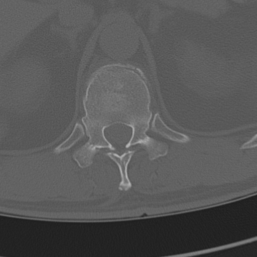 Chance fracture (Radiopaedia 33854-35020 Axial bone window 85).png