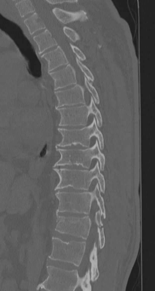Chance fracture (Radiopaedia 33854-35020 Sagittal bone window 49).png