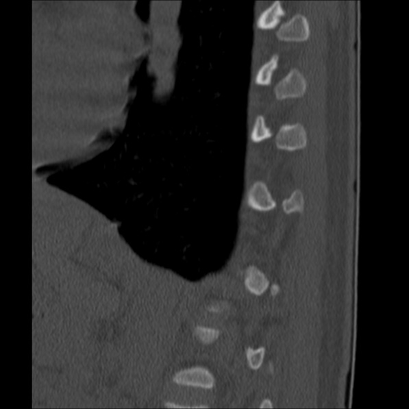 Chance fracture (Radiopaedia 36521-38081 Sagittal bone window 59).jpg