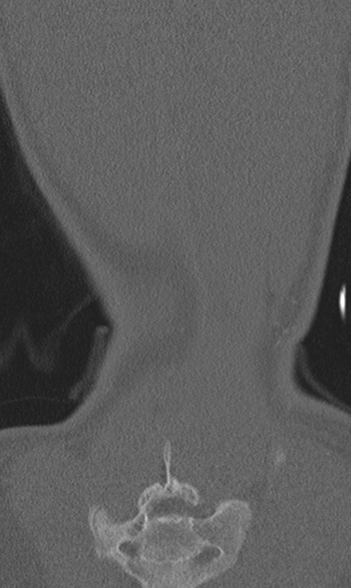 Chance fracture (Radiopaedia 40360-42912 Coronal bone window 68).png