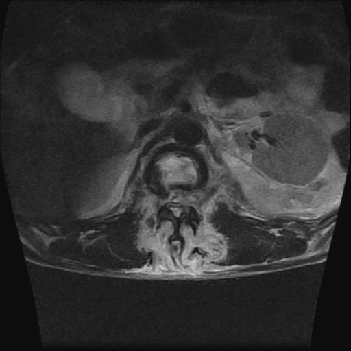 File:Chance type fracture (Radiopaedia 31020-31725 Axial T2 12).jpg