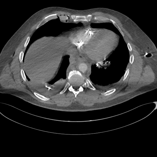 File:Chest multitrauma - aortic injury (Radiopaedia 34708-36147 A 213).png