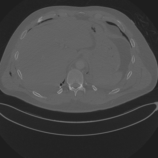 Chest multitrauma - aortic injury (Radiopaedia 34708-36147 Axial bone window 262).png