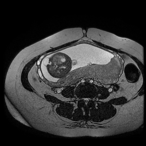 Chiari II malformation - fetal MRI (Radiopaedia 68099-77581 Axial Fiesta 16).jpg
