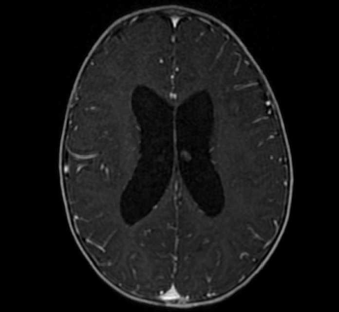 Chiasmatic-hypothalamic glioma (Radiopaedia 90079-107252 Axial T1 C+ 56).jpg