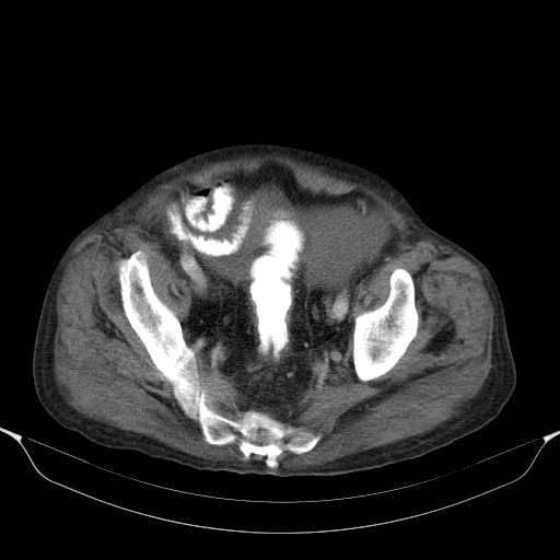 File:Cholangitis and abscess formation in a patient with cholangiocarcinoma (Radiopaedia 21194-21100 A 43).jpg
