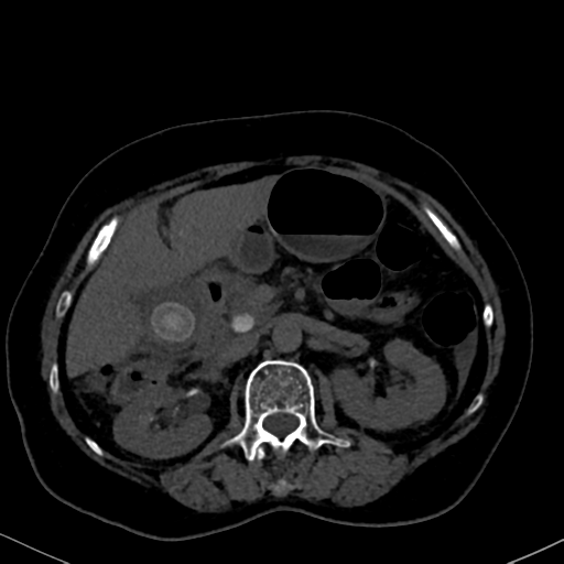 File:Cholecystitis - obstructive choledocholitiasis (CT intravenous cholangiography) (Radiopaedia 43966-47479 Axial 98).png