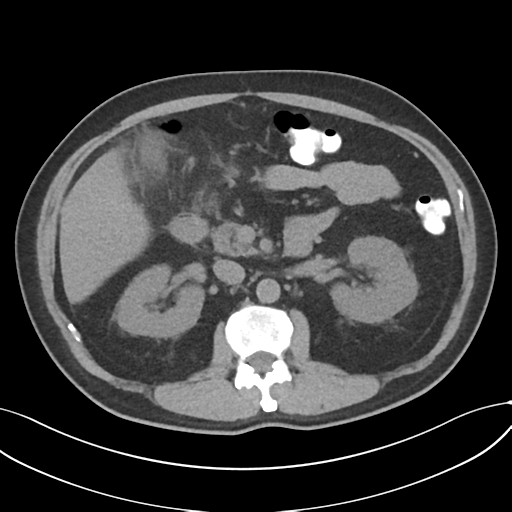 Cholecystitis with focal perforation and hepatic abscess (Radiopaedia 37189-38945 Axial non-contrast 33).png