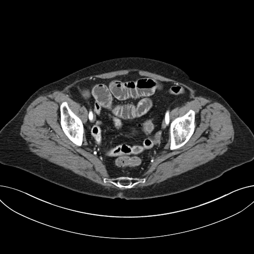 Cholecystoduodenal fistula due to calculous cholecystitis with gallstone migration (Radiopaedia 86875-103077 A 63).jpg