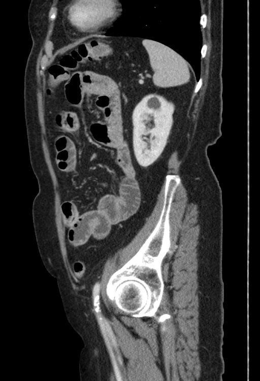 Cholecystoduodenal fistula due to calculous cholecystitis with gallstone migration (Radiopaedia 86875-103077 F 14).jpg