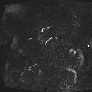 Choledochal cyst - type Ia (Radiopaedia 85673-101454 F 28).jpg