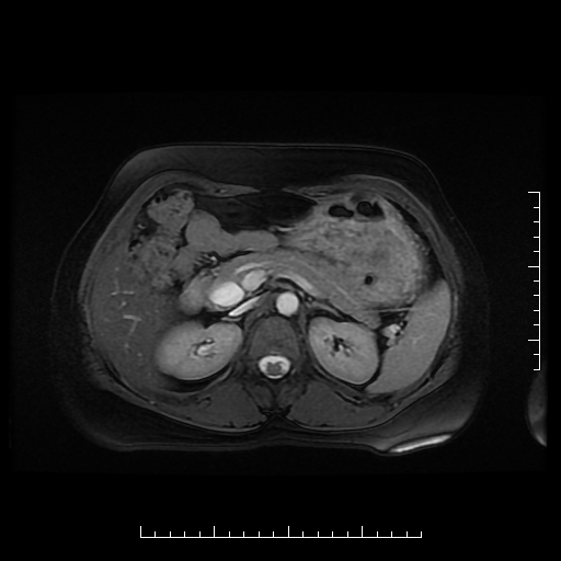 File:Choledochal cyst with chronic calcific pancreatitis (Radiopaedia 18245-18062 Axial T2 8).png