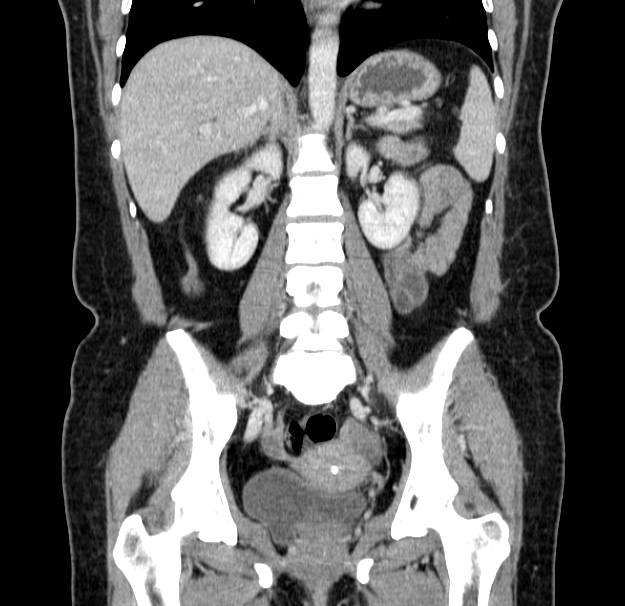 Choledocholithiasis on CT and MRI (Radiopaedia 24825-25087 C 31).jpg