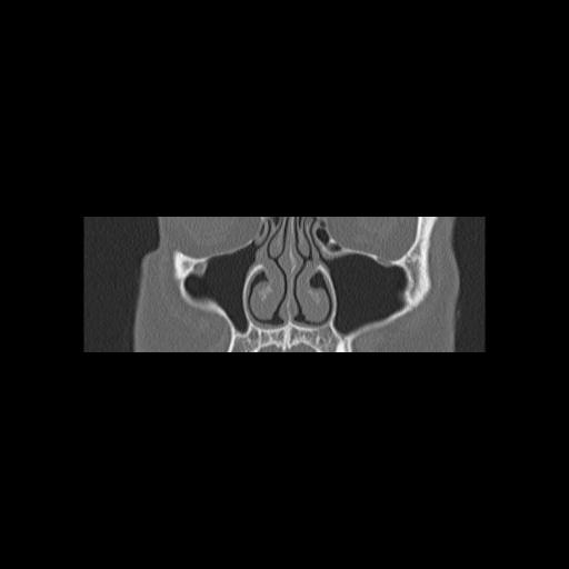 Cholesteatoma (Radiopaedia 84946-100455 Coronal bone window 33).jpg