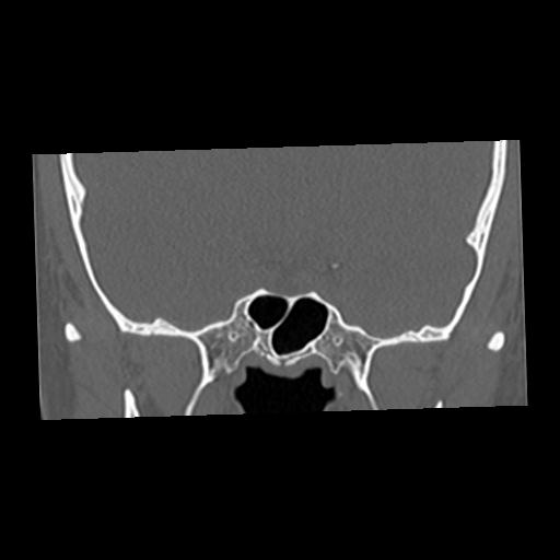 Cholesteatoma (Radiopaedia 84960-100474 Coronal bone window 6).jpg
