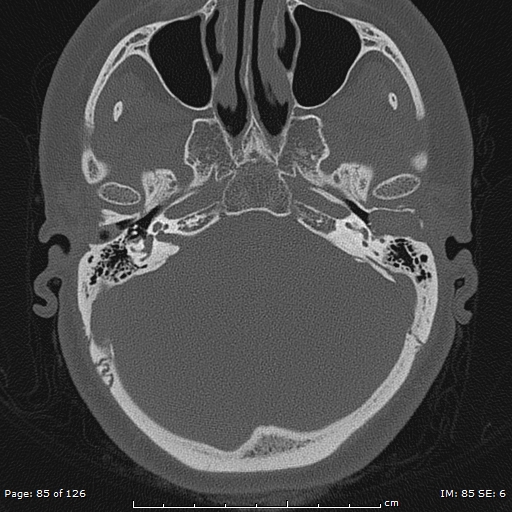 Cholesteatoma - external auditory canal (Radiopaedia 88452-105096 Axial bone window 48).jpg