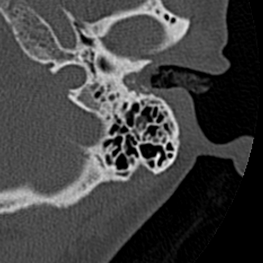 File:Cholesteatoma of the external ear (Radiopaedia 16540-16225 Axial bone window 27).jpg