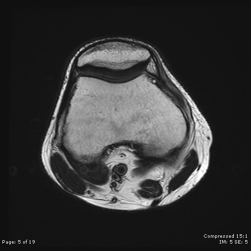 File:Chondroblastoma (Radiopaedia 25725-25891 Axial T2 5).jpg