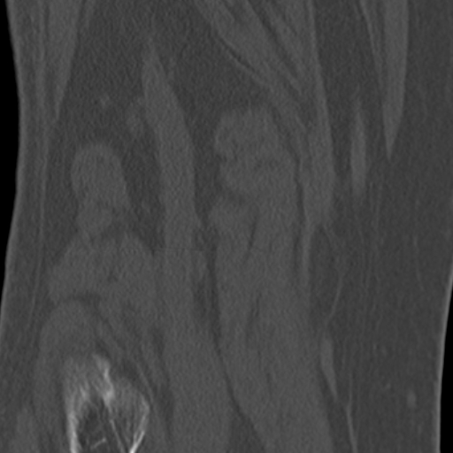 Chondrocalcinosis (Radiopaedia 16275-15955 Coronal bone window 51).jpg