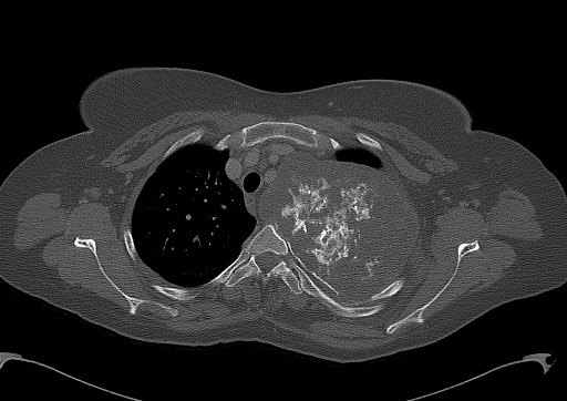 Chondrosarcoma - chest wall (Radiopaedia 65192-74199 Axial bone window 32).jpg