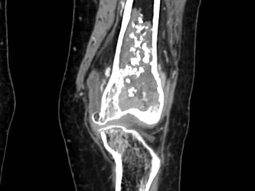 Chondrosarcoma - femur (Radiopaedia 64187-72954 C 21).jpg