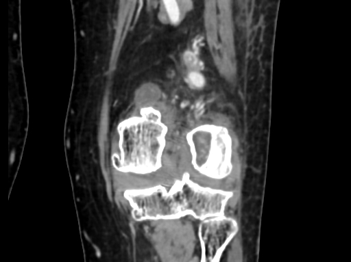 Chondrosarcoma - femur (Radiopaedia 64187-72954 C 40).jpg