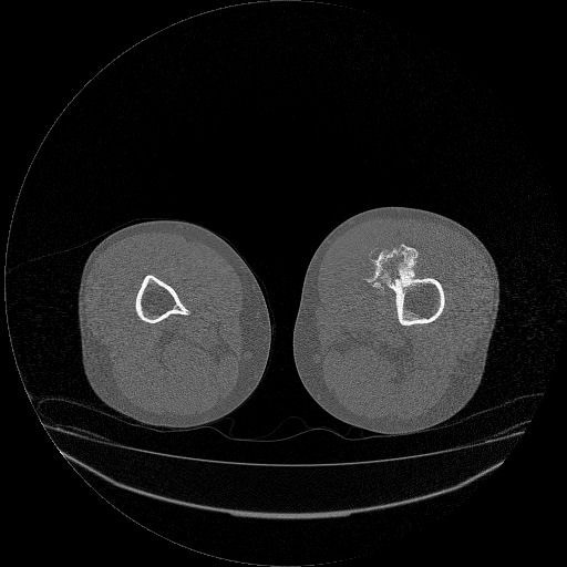 File:Chondrosarcoma arising from exostosis (Radiopaedia 59996-67507 Axial bone window 19).jpg