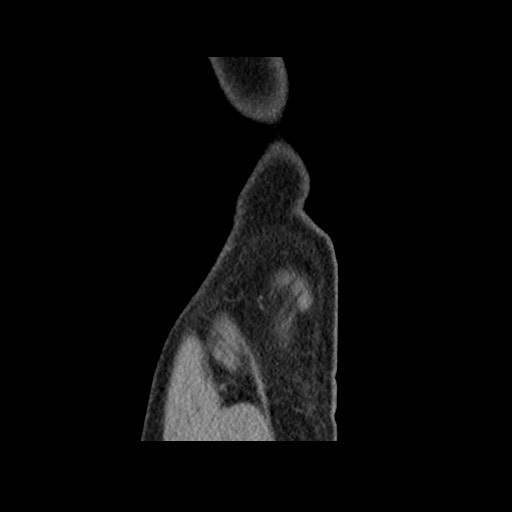 Chondrosarcoma of iliac wing (Radiopaedia 63861-72599 F 173).jpg