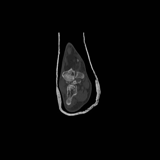 File:Chopart fracture (Radiopaedia 12386-12650 Coronal bone window 4).jpg