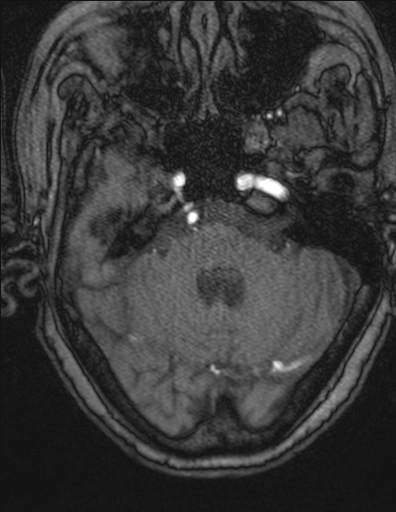 Choroid plexus xanthogranuloma - unilateral (Radiopaedia 85632-101393 Axial TOF 1).jpg