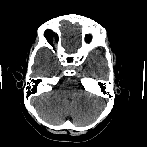 Choroid plexus xanthogranulomas (Radiopaedia 51621-57408 Axial non-contrast 24).jpg