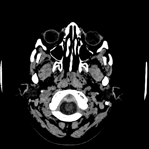 File:Choroid plexus xanthogranulomas (Radiopaedia 51621-57408 Axial non-contrast 3).jpg