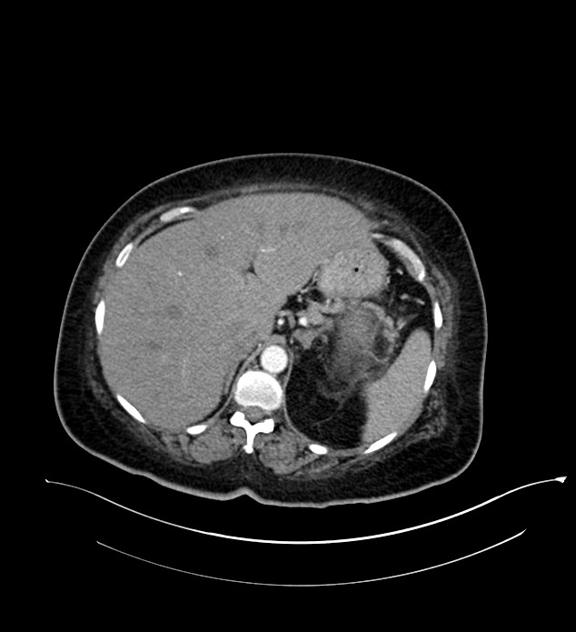 Chromophobe renal cell carcinoma (Radiopaedia 84239-99519 B 24).jpg