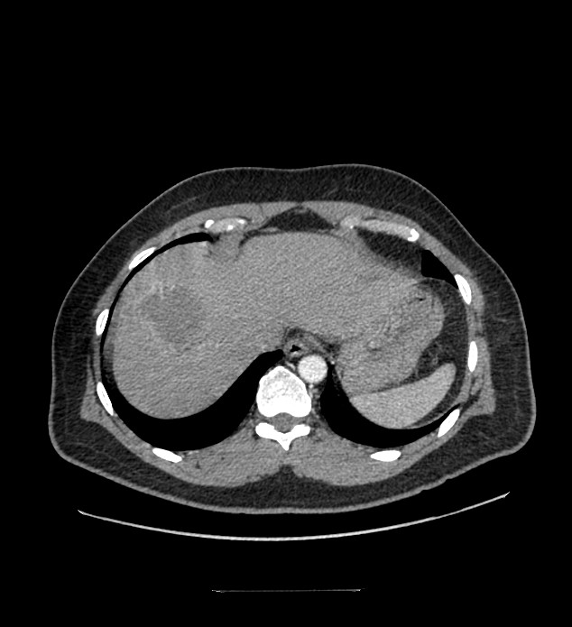 Chromophobe renal cell carcinoma (Radiopaedia 84337-99644 B 9).jpg