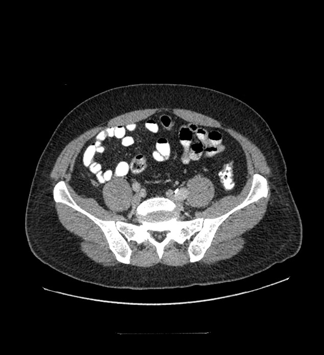 Chromophobe renal cell carcinoma (Radiopaedia 84337-99644 C 97).jpg