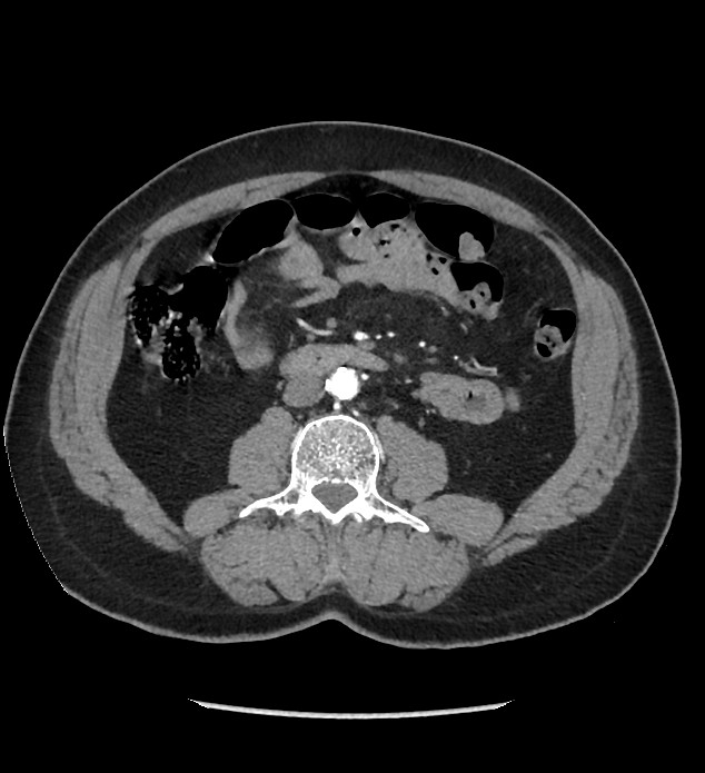 Chromophobe renal cell carcinoma (Radiopaedia 86879-103083 B 77).jpg