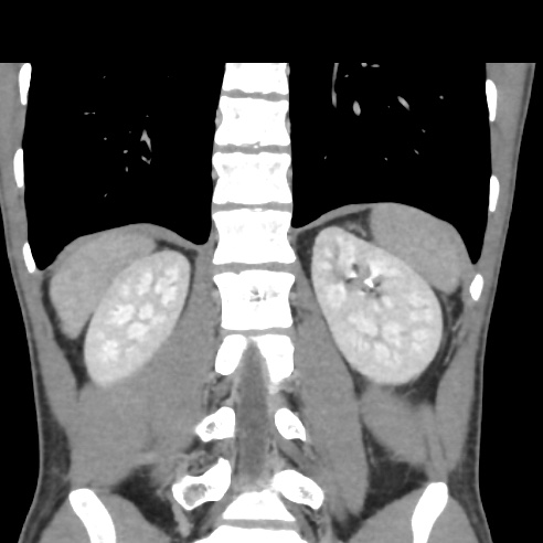 File:Chronic calcific pancreatitis (Radiopaedia 56280-62953 F 26).jpg