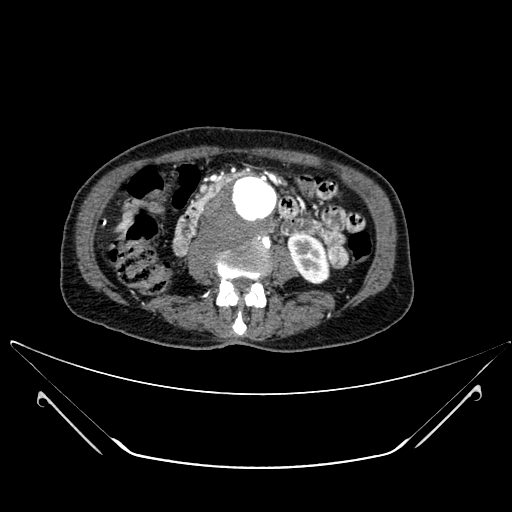 File:Chronic contained rupture of abdominal aortic aneurysm with extensive erosion of the vertebral bodies (Radiopaedia 55450-61901 A 31).jpg